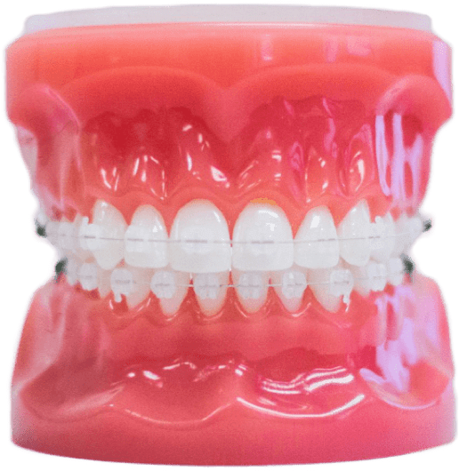 Clear Braces Clear Braces