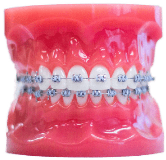 Metal Braces Metal Braces